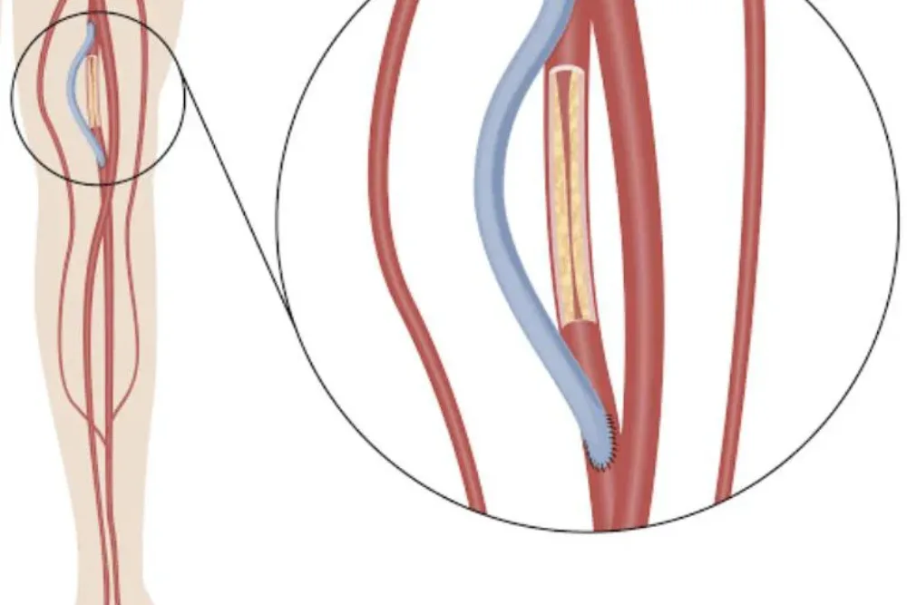 Bypass arterial