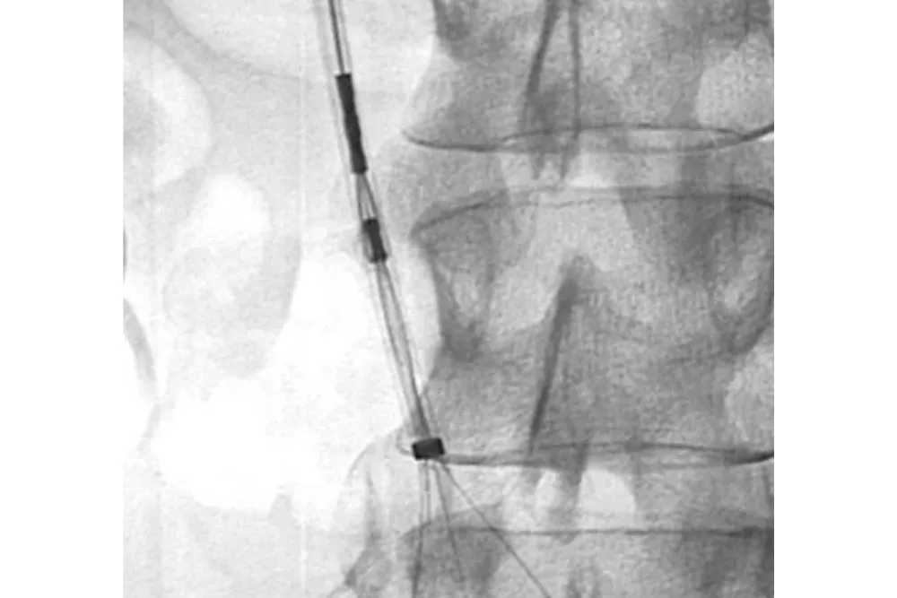 Colocación de filtro de vena cava