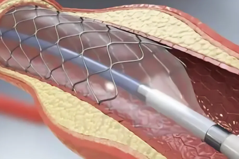 Colocación de stent en enfermedad arterial periférica