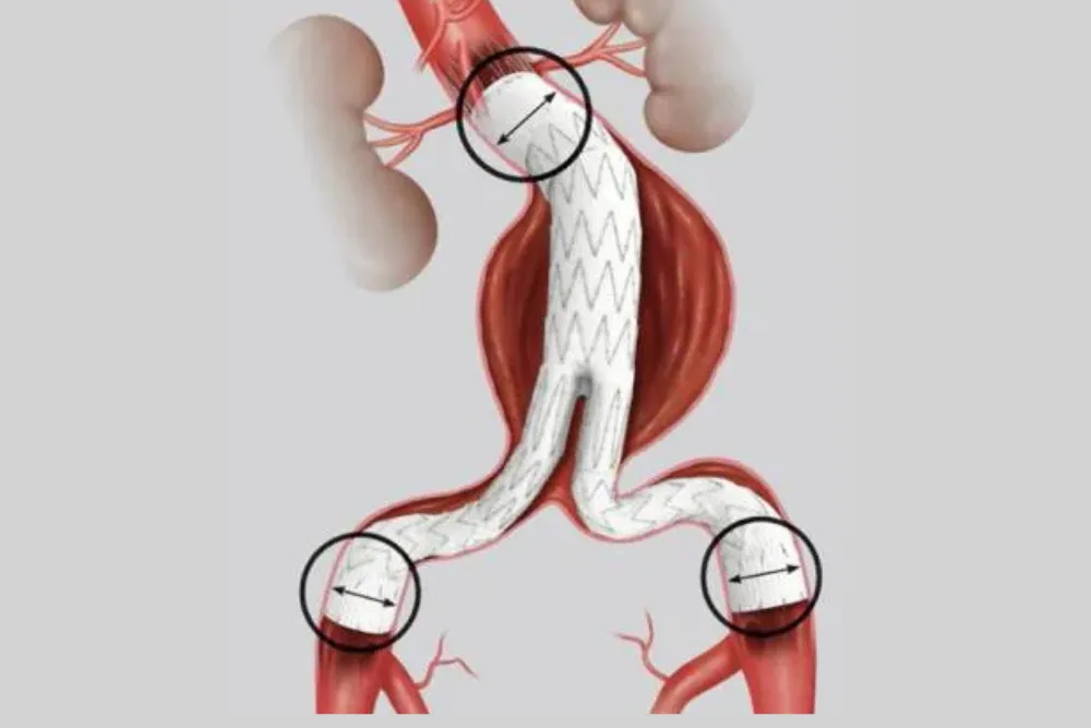 Colocación de endoprótesis para aneurisma de aorta (EVAR)